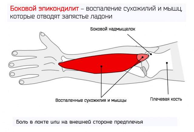 Ортез локтевого сустава при эпикондилите фото