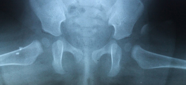 Как делают рентген тазобедренного сустава