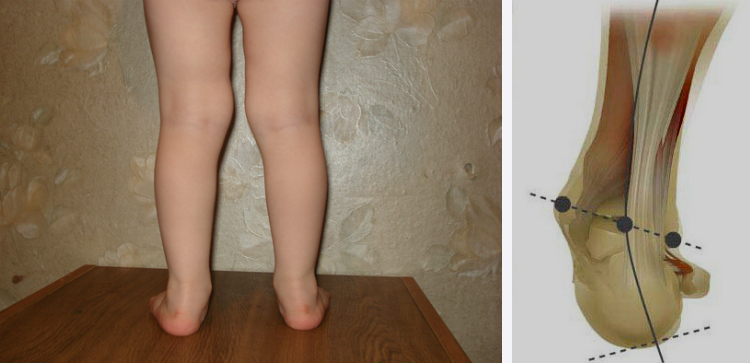 Особенности вальгусной деформации стопы у детей симптомы, лечение и профилактика