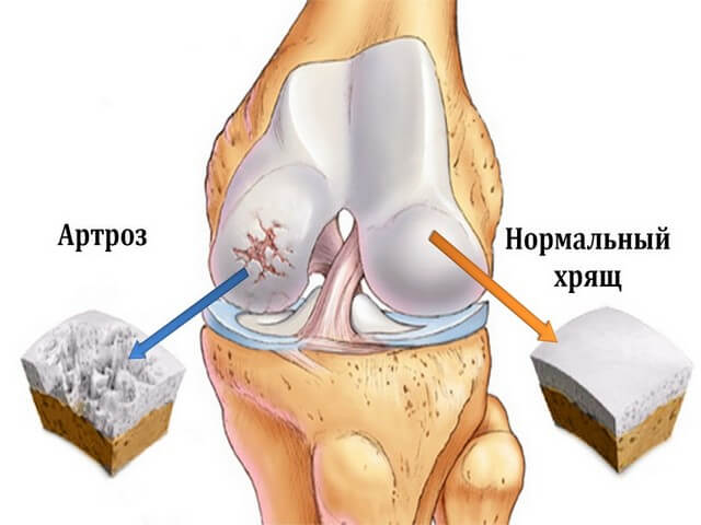 Боль в мышцах ног выше колена лечение