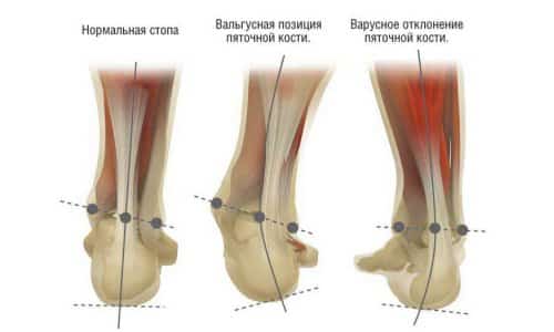 Ортопедическая обувь для женщин при вальгусной деформации