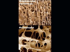 Физиотерапия при остеопорозе