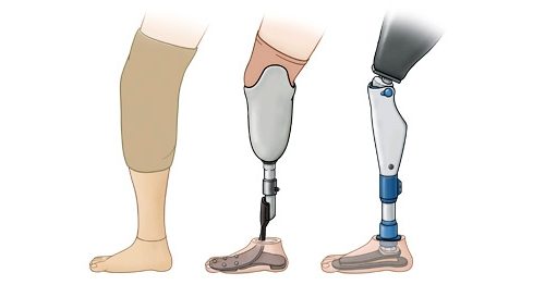 Современные протезы ног. Протезирование нижних конечностей