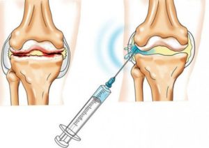 Лечение суставовОзонотерапия при артрозе коленного сустава