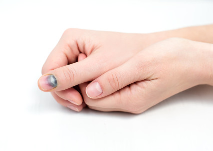 Ушиб сустава пальца руки что делать, лечение травмы большого пальца