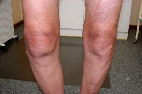 Наколенник при артрозе коленного сустава