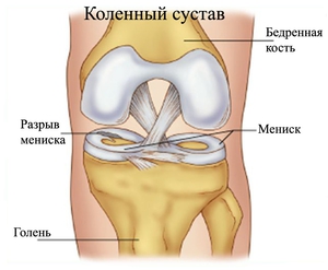 Не хрустиМенископатия коленного сустава симптомы