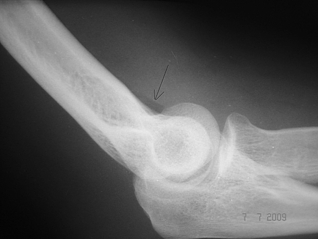Рентген локтевого сустава проведение, противопоказания