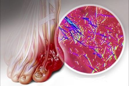 Связь между мочевой кислотой и болями в суставах