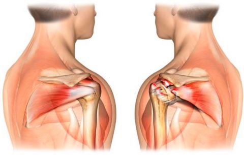 Как лечить разрыв АКС плечевого сустава