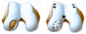 Хондропластика коленного сустава разновидности операции
