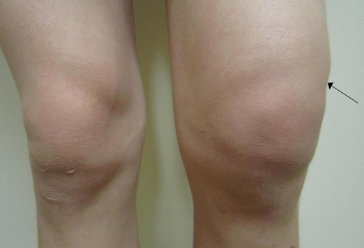 Препателлярный бурсит коленного сустава