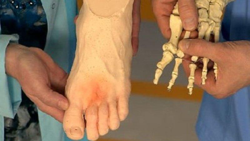 Причины, лечение и восстановление после перелома плюсневой кости стопы