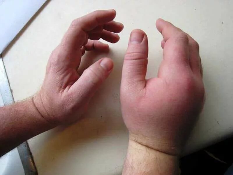 Ревматоидный артрит кистей рук