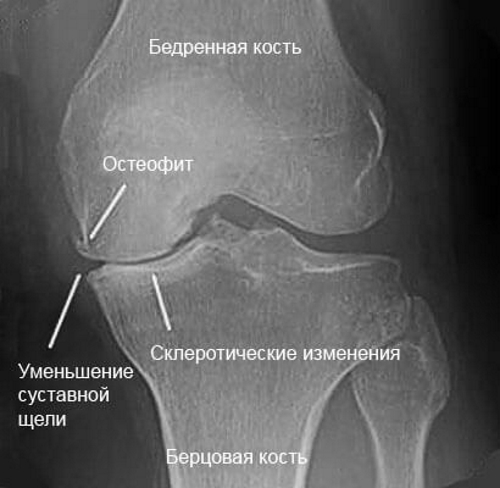 Гонартроз коленного сустава 2 степени