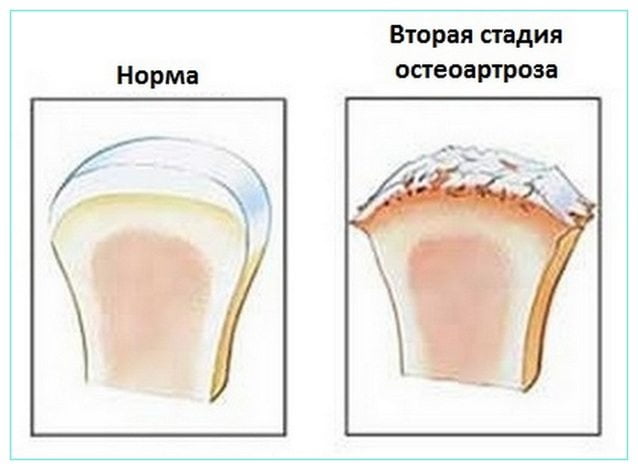 Лечение остеоартроза голеностопного сустава ДОА 1 и 2 степени