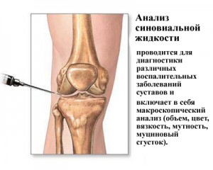 Эффективные мази для лечения суставов колена