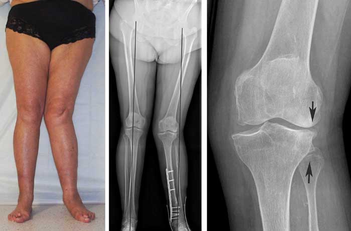 Разрыв мениска коленного сустава