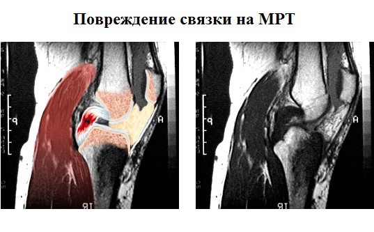 Как проходит магнитно-резонансная томография коленного сустава