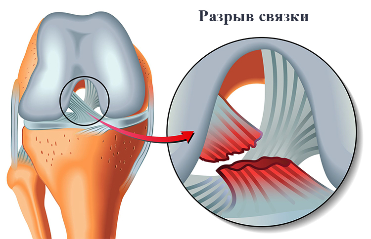 Строение коленного сустава человекаСтроение коленного сустава человека