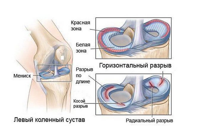 Воспаление лимфоузлов под коленкой. Причины боли под коленом сзади