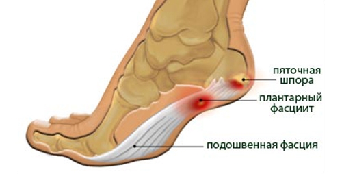 Остеофиты коленного сустава лечение народными средствами