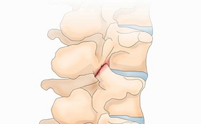 Спондилоартроз остеоартроз межпозвонкового сустава