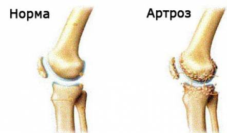 Эффективные методы лечения гонартроза коленного сустава 3 степени