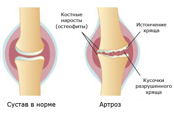 Что такое и как лечить артроз коленного сустава 1,2,3 степени